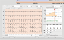 MetaSoft Studio - rozhraní pro 12kanálové EKG